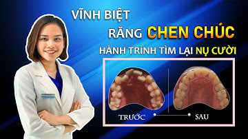 #Case 22 - Vĩnh Biệt Răng Chen Chúc - Hành Trình Tìm Lại Nụ Cười Tuyệt Vời