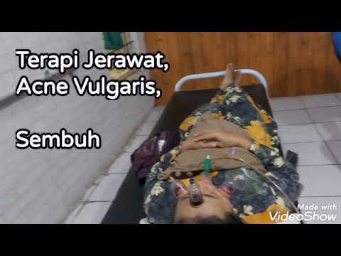 Tempat terapi wajah jerawat, terapi acne vulgaris, kecantikan, kulit wajah menjadi halus, bekam wajah di Jember Jawa Timur