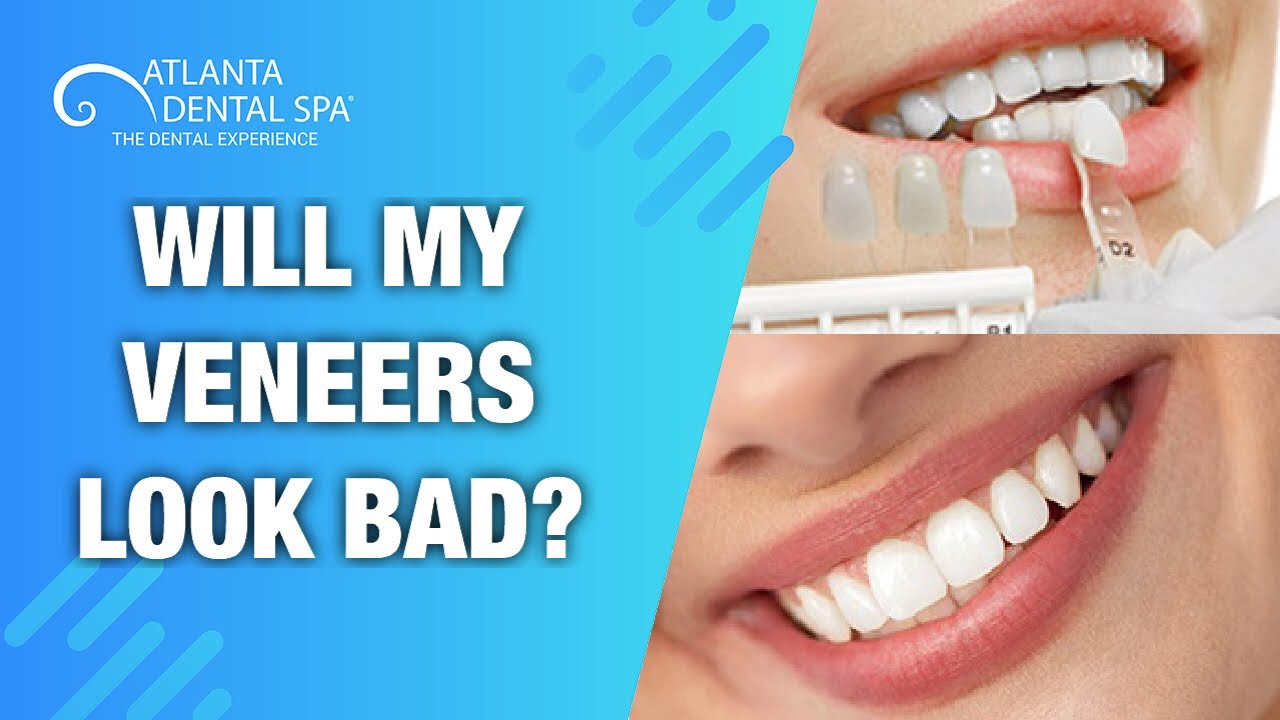 Will my Veneers look Fake?? (2019) YouTube