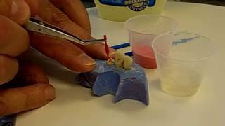 Cast Post Core Using GC Pattern Resin - Dr. Antonelli