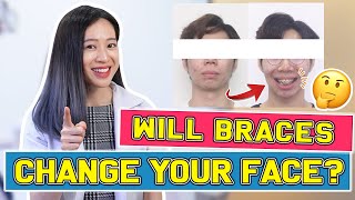 Will Braces Change Your FACE? | #BraceYourself​!