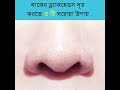 নাকের ব্ল্যাকহেডস দূর করতে ৩ টি  ঘরোয়া উপায়