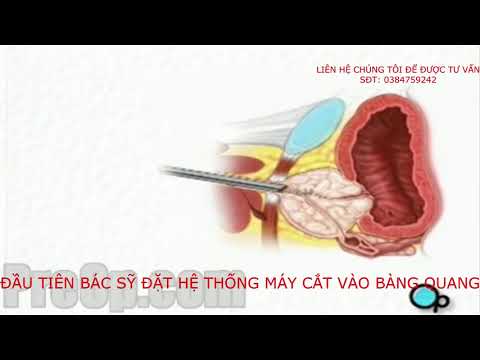 Cắt u phì đại tuyến tiền liệt qua nội soi tại bệnh viện Đại Học Y  Hà Nội- TURP