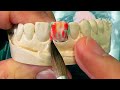 How To Match A Single Ceramic Tooth - Expert Method