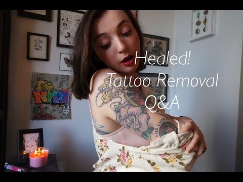 Tattoo Removal, Healed q&amp;a! - YouTube