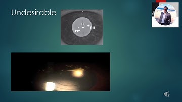 The Importance of Multifocal IOL Centration Video (Website address changed to quickguide.org)
