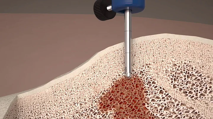 Madison™ Bone Biopsy System Procedure - 天天要聞