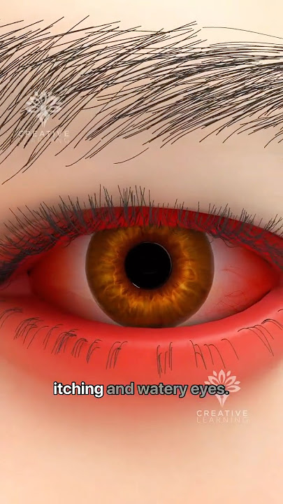 Download lagu What Is Conjunctivitis (Pink Eye) #shorts #viralvideo - Creativelearning3d