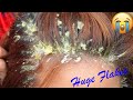 Scratching Huge Flakes (Dandruff) !! | Scratching And picking Flakes In Hair #130