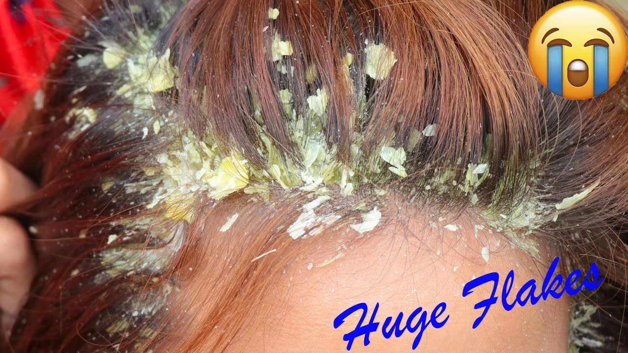 Scratching Huge Flakes (Dandruff) !! Scratching And picking Flakes In Hair 130 YouTube