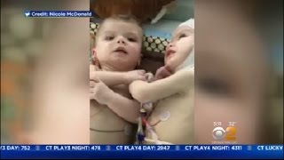 New Video Of Twins After Separation Surgery