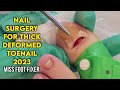 NAIL SURGERY FOR THICK DEFORMED TOENAIL 2023 BY MISS FOOT FIXER
