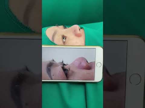 Video Nâng mũi S-line tự nhiên DR VĨNH - Khoa Thẩm Mỹ Bệnh... - youtube