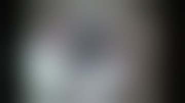 SOFT CATARACT PHACOEMULSIFICATION - Dr Saurav Piya