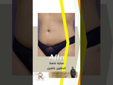 قبل و بعد لعملية شد الترهلات البطن مع نحت و شفط البطن