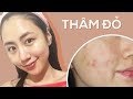 THÂM ĐỎ VÀ CUỘC CHIẾN ĐIỀU TRỊ CHÚNG LÀNH NHANH NHẤT | PIE - Post Inflammatory Erythema 101