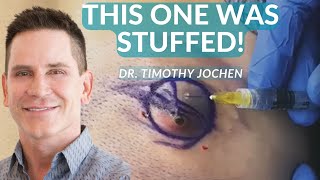 This Cyst Was A Big Gooey Mess