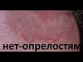 Как избавиться от опрелостей/How to get rid of diaper rash