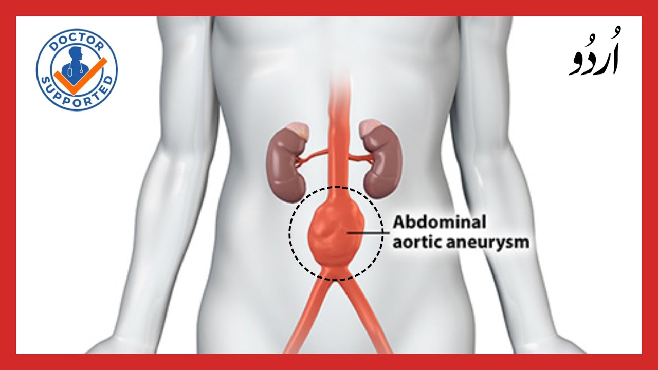 Abdominal Aortic Aneurysm Explained in urdu YouTube