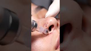 Extreme Blackhead Suction — No Talking ASMR #macroasmr #blackheadcaique #satisfying #satisfyling