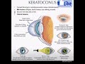 #keratoconus #optometrist #optometry #healthcare #visioncare #alliedhealth #diseaseawareness