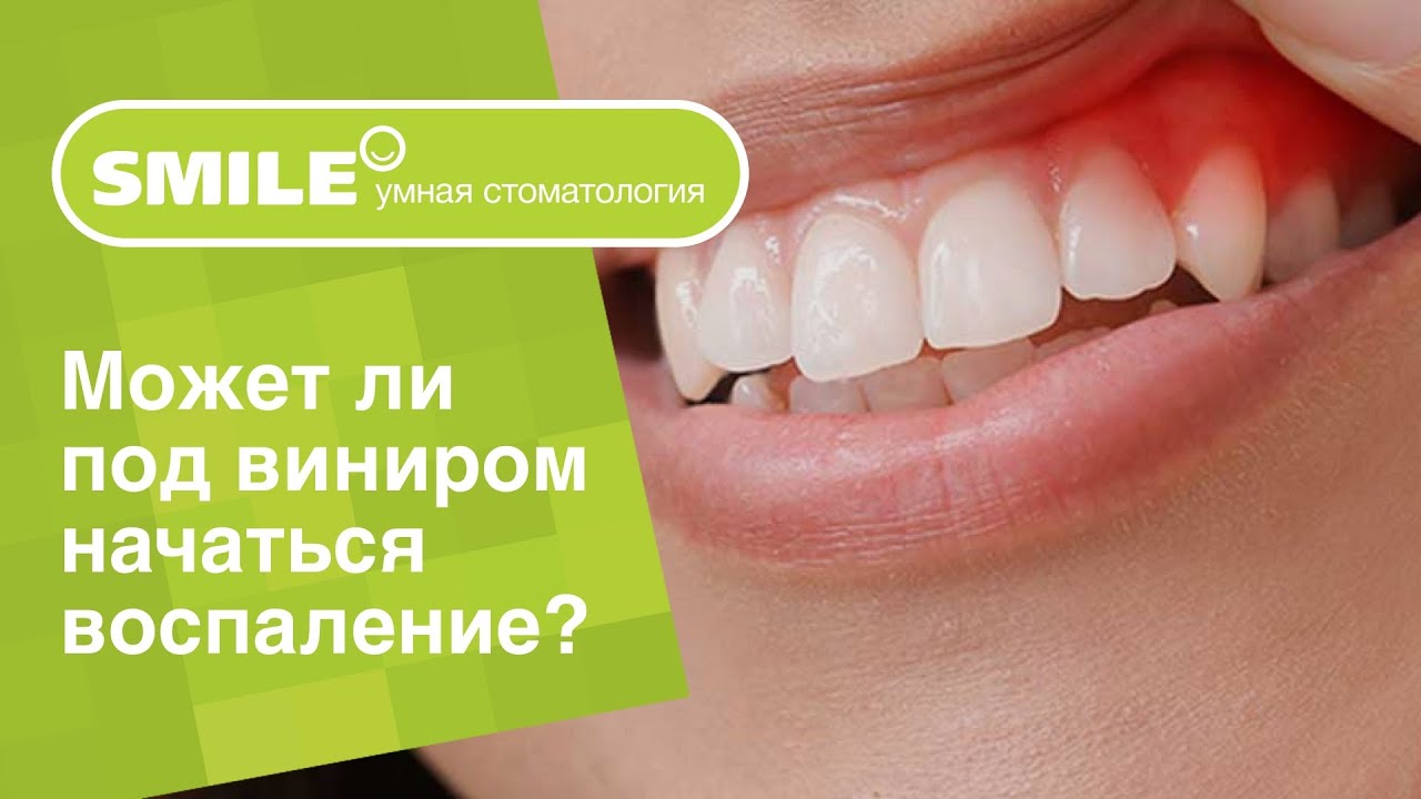 👉 Может ли после установки виниров начаться воспаление?