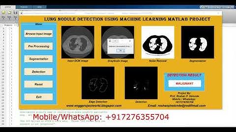 Lung Nodule Classification Using Machine Learning Matlab Project With Source Code Nodule Detection