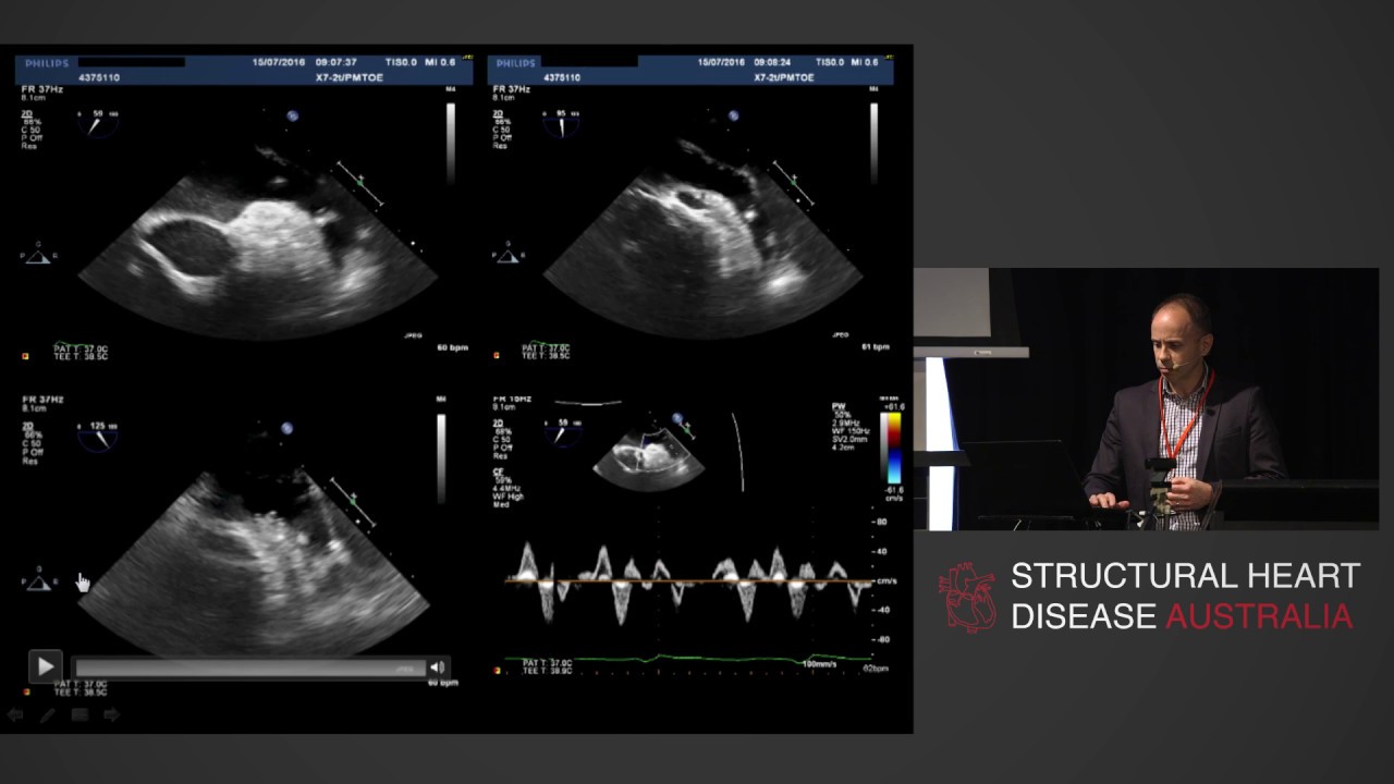 Detection of Left Atrial Thrombus - A/Prof Phillip Mottram