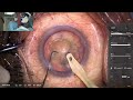 Live cataract surgery by dr naren shetty uttara eyecon 2022 at drishti eye institute