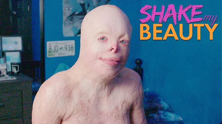 I Have 95% Burns - But I'm Thriving | SHAKE MY BEA...