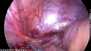 laparoscopic vasicovaginal fistula