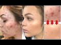 How to Remove Pimples, Dark Spots &amp; Whiteheads in 2 days! How To Get Rid Of Acne Overnight With Garl