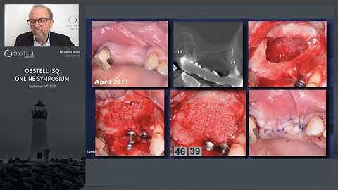 Utilization for conventional loading at 8 weeks in sinus grafting cases