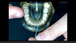 Realinhamento de incisivo inferior - Realigment of inferior incisor crowding relapse
