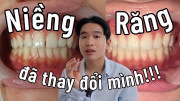 niềng răng giúp mình lột xác!!! toàn cảnh hành trình niềng răng trong suốt