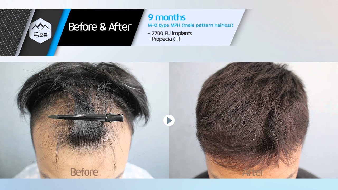 Pattern Hair Loss Magnificent Ideas Pattern Hair Loss Magnificent Ideas
