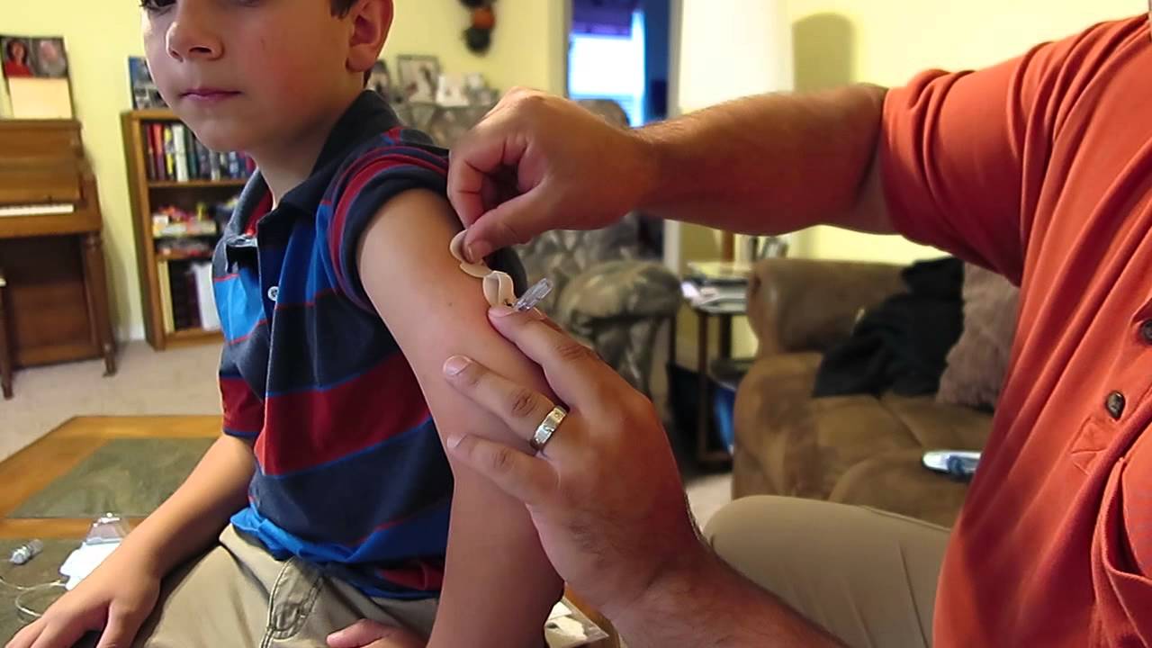 Medtronic Enlite Sensor Insertion WITHOUT Enlite Serter Device