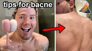 5 TIPS FOR PEOPLE WITH BODY ACNE!🌋 (how I got rid of mine in a few weeks)