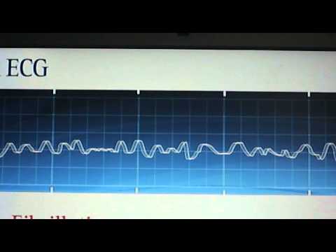 Ventricular Fibrillation - YouTube