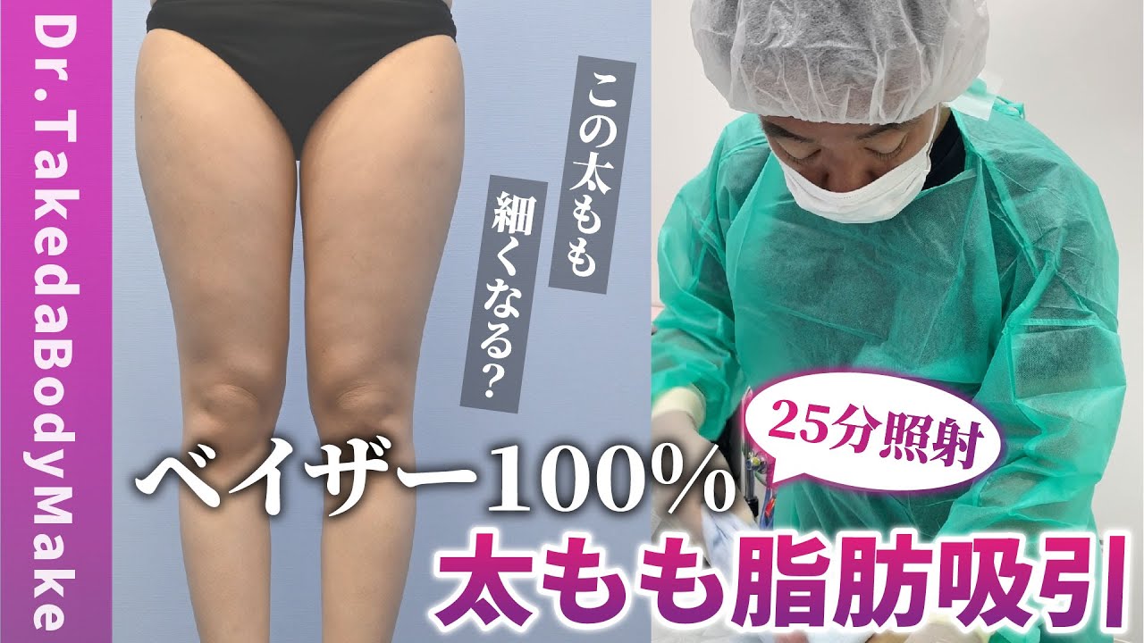ポコっと出たセルライト撲滅！ベイザーで溶かした皮下脂肪を3400CC
