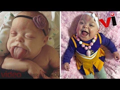 16개월 된 아기, 성인 크기보다 두 배 더 큰 혀, 2번의 수술 후 첫 미소