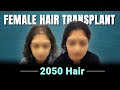 Female hair transplant in india   after 10 months dhi result  full process