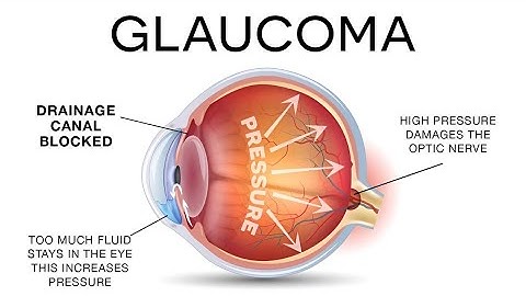 What is Glaucoma ? Animated Video