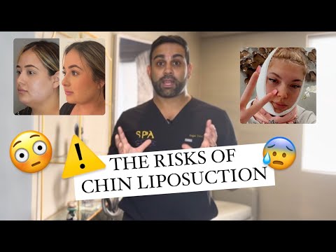 Video: Har någon dött av chin lipo?