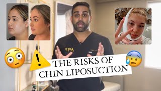 What are the RISKS of chin liposuction?? *MUST WATCH BEFORE DOUBLE CHIN SURGERY*