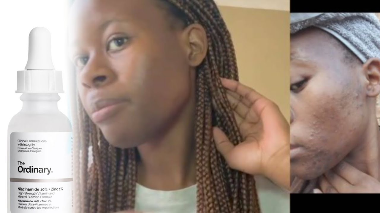 How I got rid of my acne *1 product that changed my life* | Makhosi ...