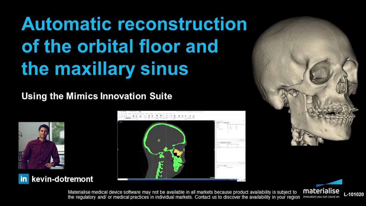 Automatic Reconstruction Of The Orbital Floor And Maxillar Sinus Materialise Mimics 22 You