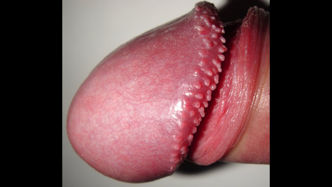 can u get rid of pearly penile papules, pearly penile papules vs herpes, .....