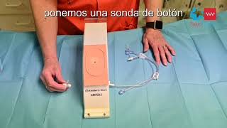 Hospital Gregorio Marañón - Gastrostomía Endoscópica Percutánea. Sonda de Botón