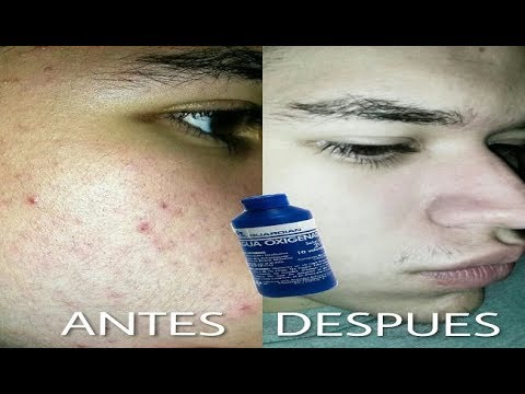 COMO ELIMINAR EL ACNE Y LAS ESPINILLAS CON AGUA OXIGENADA | REMEDIO CASERO | Jack Cesar